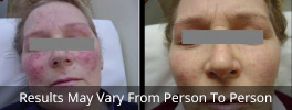 Rosacea treatment before and after
