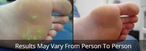 wart removal treatment before and after
