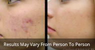 Acne treatment before and after 3