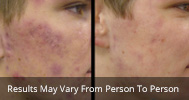 Acne treatment before and after 1