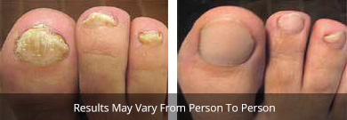 Onychomycosis treatment before and after